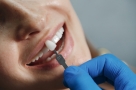 Реставрация зубов винирами: плюсы, минусы и противопоказания